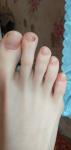 Изменение цвета ногтя на ноге фото 1