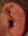 Уплотнения на ушных раковинах фото 1