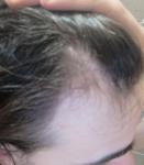 Возможно ли восстановить волосы после кратковременного выпадения? фото 1