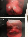 Хронически красное горло и закашливание фото 2