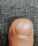 Резкое ухудшение состояния ногтей фото 1