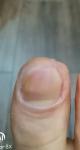 Резкое ухудшение состояния ногтей фото 2