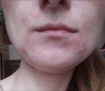 Проблемы с кожей лица, раздражение, болезненность, краснота фото 3