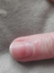 Утолщение ногтей рук фото 1