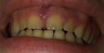 Воспаление десны переднего зуба фото 1