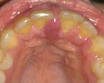 Воспаление десны переднего зуба фото 2