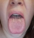 Болит язык. Больно кушать фото 1