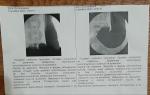Хронический гастрит, гастропотоз- 2 ст фото 1
