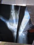 Перелом первой пястной кости руки фото 2