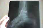 Перелом лодыжки рентген фото 1