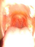 Постоянное воспаление в горле фото 4