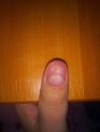 Помогите! Проблема с ногтём большого пальца руки! фото 1