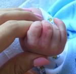 Гноится глаз у новорожденного на фоне капель, + мелкие вопросы фото 1