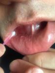 Пузырек с полупрозрачным содержимым на внутренней стороне нижней губы фото 2