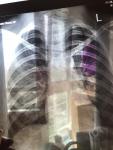 По рентгену пневмания-но спорный диагноз фото 2