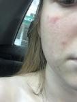 Аллергия на лице или ожог фото 1