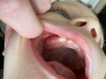 Лезет зуб, сильно опухшая десна фото 2