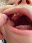 Лезет зуб, сильно опухшая десна фото 1