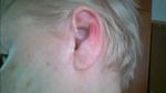 Шишки и мозоли на завитках ушных раковин фото 1