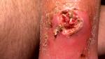 Вопрос по колотой и инфицированной ране голени (осложнения! фото 4