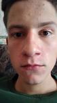 Себорейный дерматит на лице в районе носа у 18летнего парня фото 4