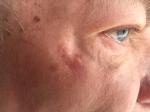 Возможность лечения многолетнего нароста на коже у глаза фото 1