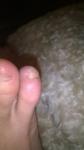 Воспаление между пальцами ног фото 3