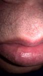 Белая шишка с внутренней стороны нижней губы фото 2