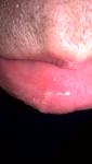 Белая шишка с внутренней стороны нижней губы фото 3