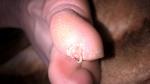 Сосуд над ногтевой пластиной на ноге фото 1