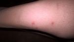Сыпь в виде комариных укусов фото 2
