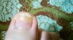 Заболевание ногтей фото 1