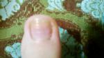 Заболевание ногтей фото 2