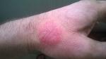 Воспаление кожи на руке фото 2