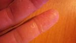 Шелушение кожи на пальцах рук фото 1