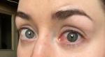 Красные сосуды в глазах и напряжение (8 месяцев) фото 4