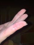 Атопический дерматит, грибок кожи рук и ногтей, что это? фото 1