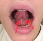Воспаление под языком, образование рядом с горлом фото 4