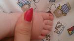 Нарост впритык к ногтям больших пальцев на ногах ребенка фото 1