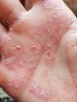 Заболевание кожи ладоней рук фото 3