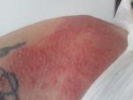 Аллергия на пантенол фото 1