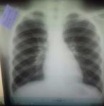 Рентген грудной клетки, не лечиться кашель фото 5
