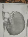 Инородное тело в проекции лобной кости фото 3