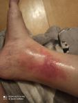 Аллергия на ноге, красное пятно, чешется фото 1