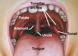 Adenoid-Mouth