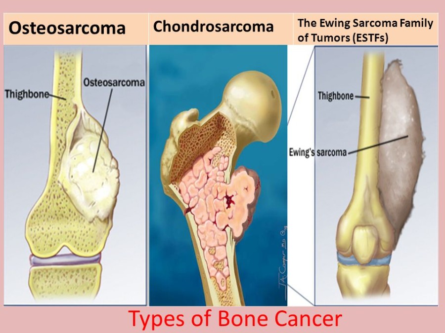 osteosarkoma