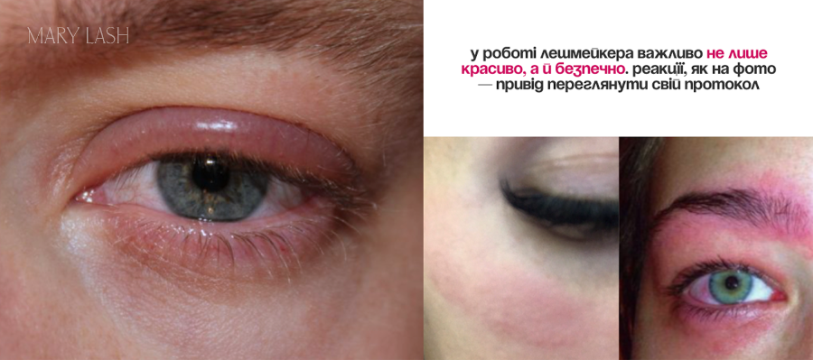 алергія вій