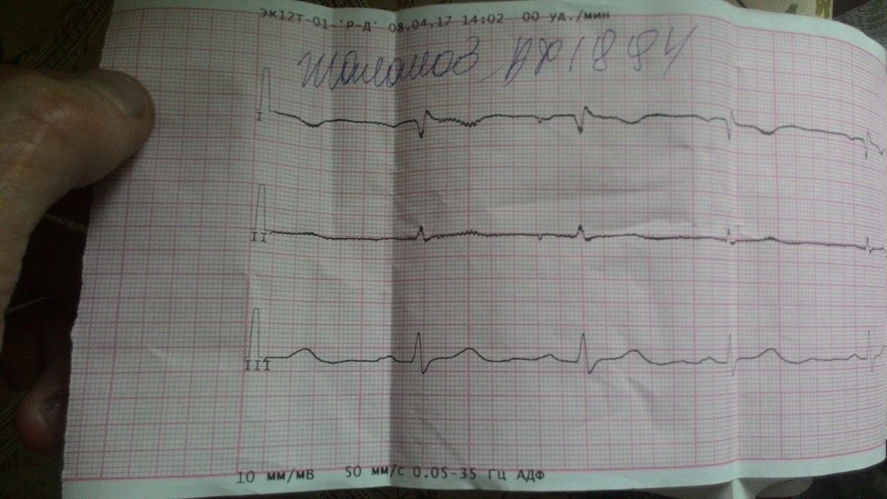Фото нормальной кардиограммы сердца и плохой