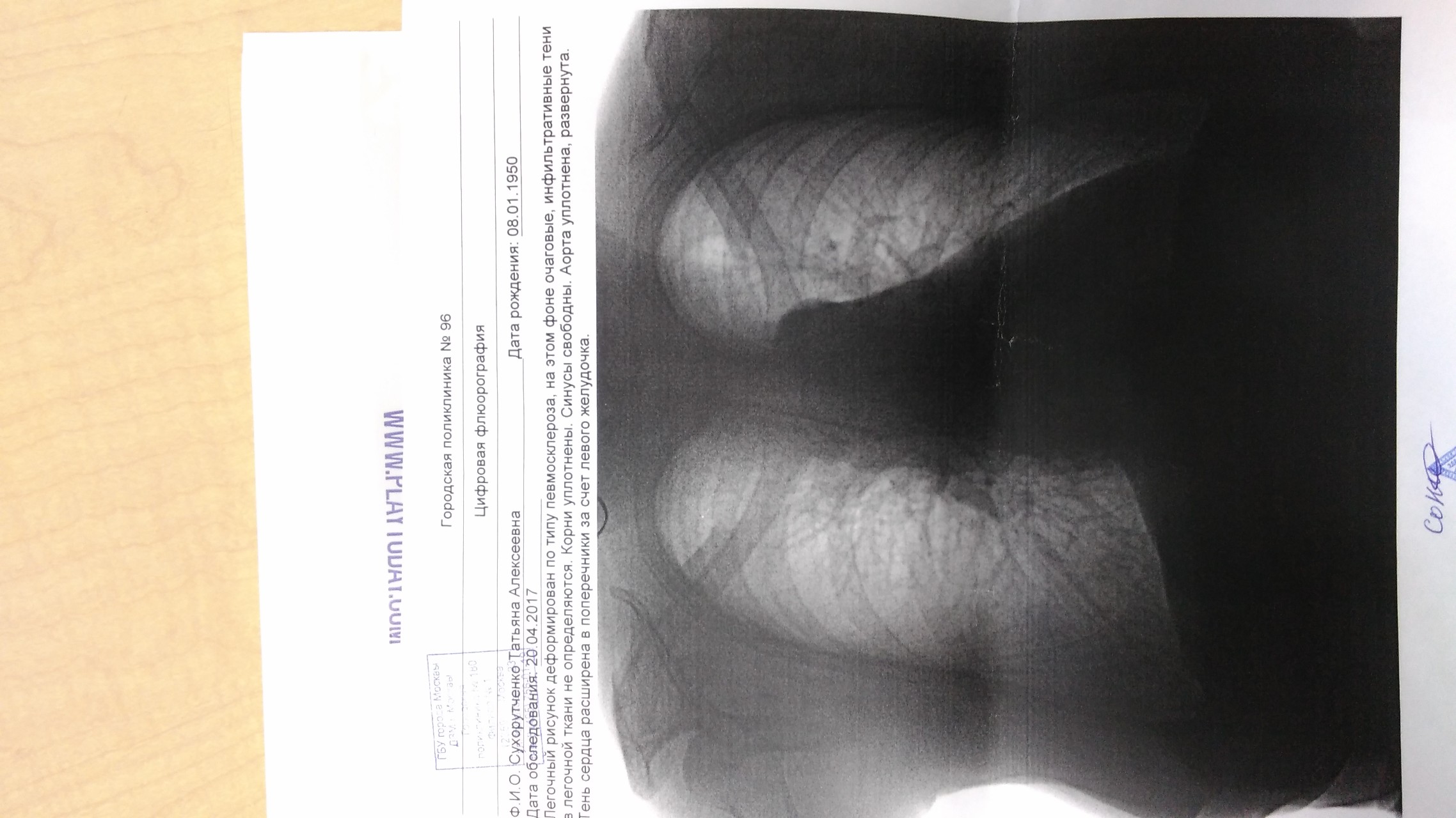 Флюорография какого. Флюорография расшифровка снимков. Результат флюорографии со снимком. Результат флюорографии легких. Флюорография легких заключение.