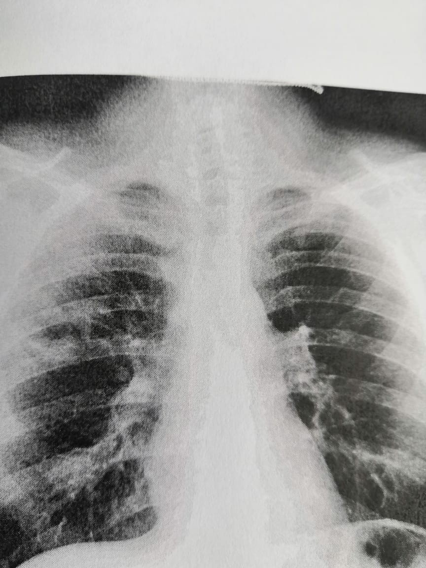 После поражение легких. Поражение легких на рентгене. Лёгкие при коронавирусе на рентгене. Снимок с поражением легких при коронавирусе.